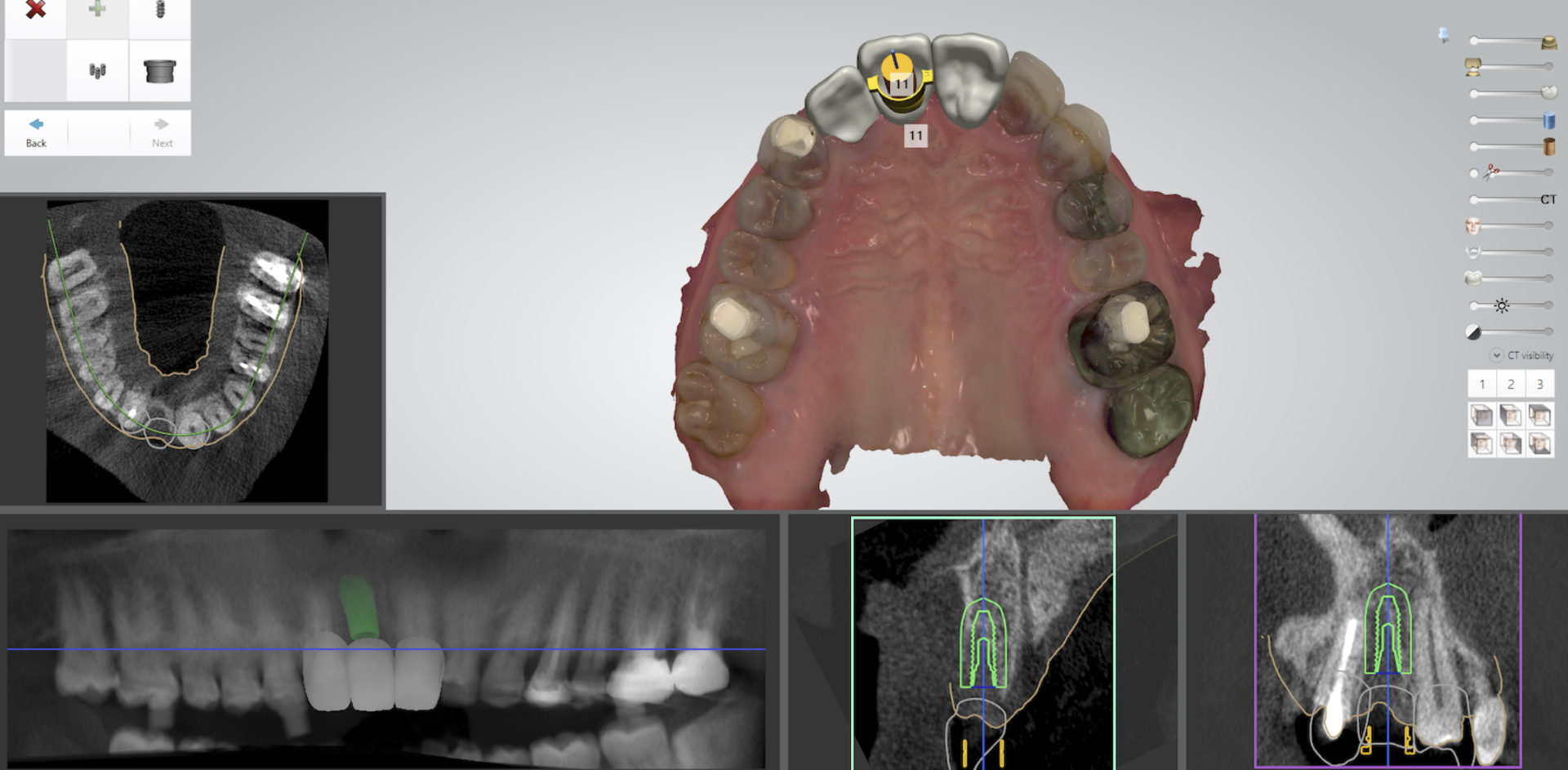 小嶋デンタルクリニックのインプラント治療の流れ　CT撮影