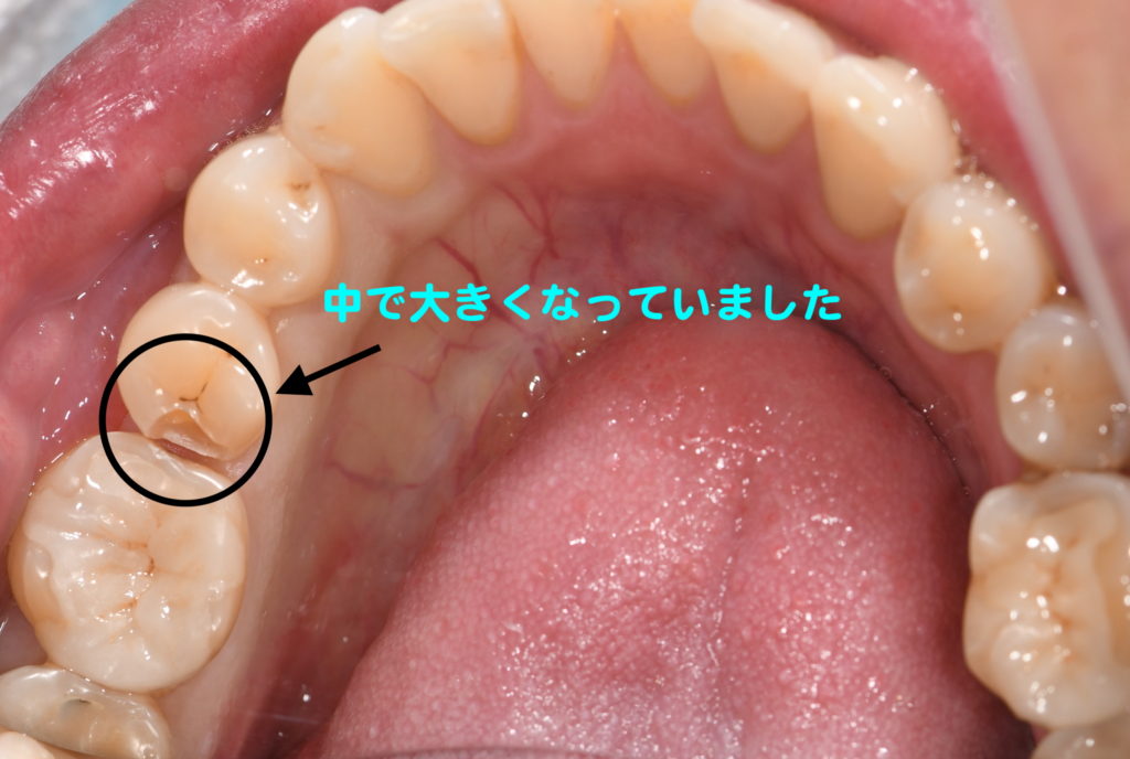 歯の中で広がっている虫歯 ネット予約可 静岡市の歯医者は小嶋デンタルクリニック
