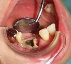 骨粗鬆症の方の抜歯について ネット予約可 静岡市の歯医者は小嶋デンタルクリニック
