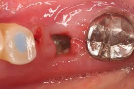 骨粗鬆症の方の抜歯について ネット予約可 静岡市の歯医者は小嶋デンタルクリニック