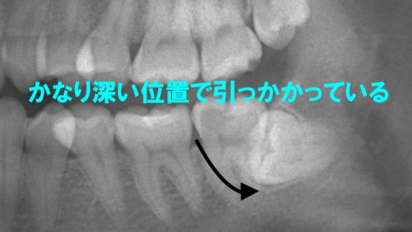 下顎埋伏智歯抜歯 ネット予約可 静岡市の歯医者は小嶋デンタルクリニック