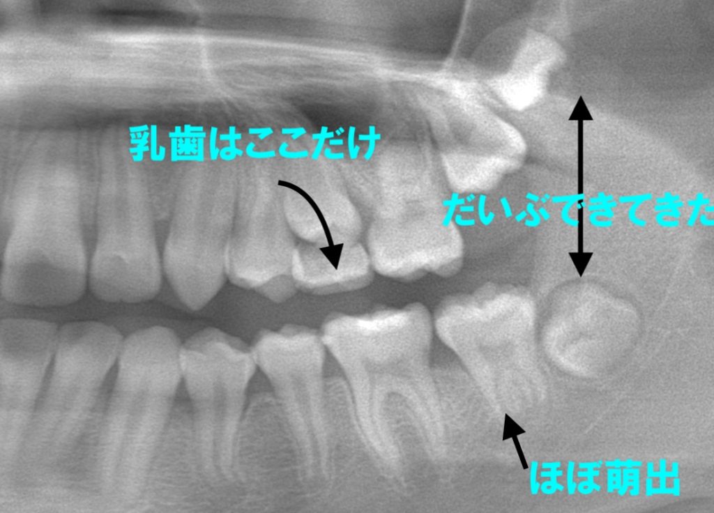 乳歯から永久歯への交換期 ネット予約可 静岡市の歯医者は小嶋デンタルクリニック