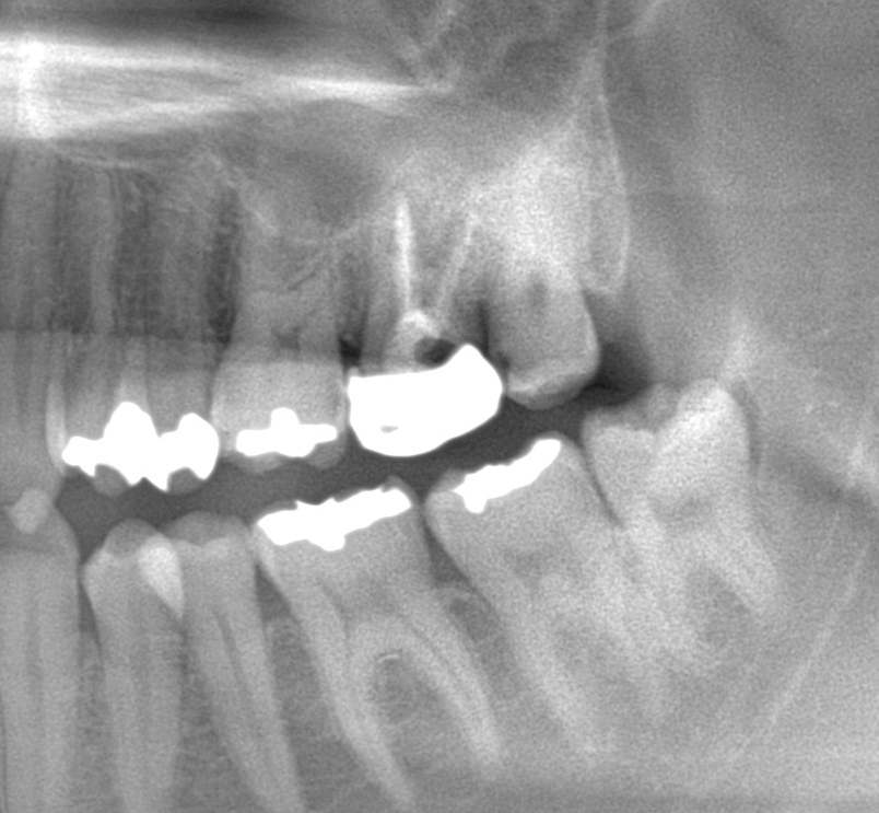 銀 歯 の 下 虫歯 レントゲン