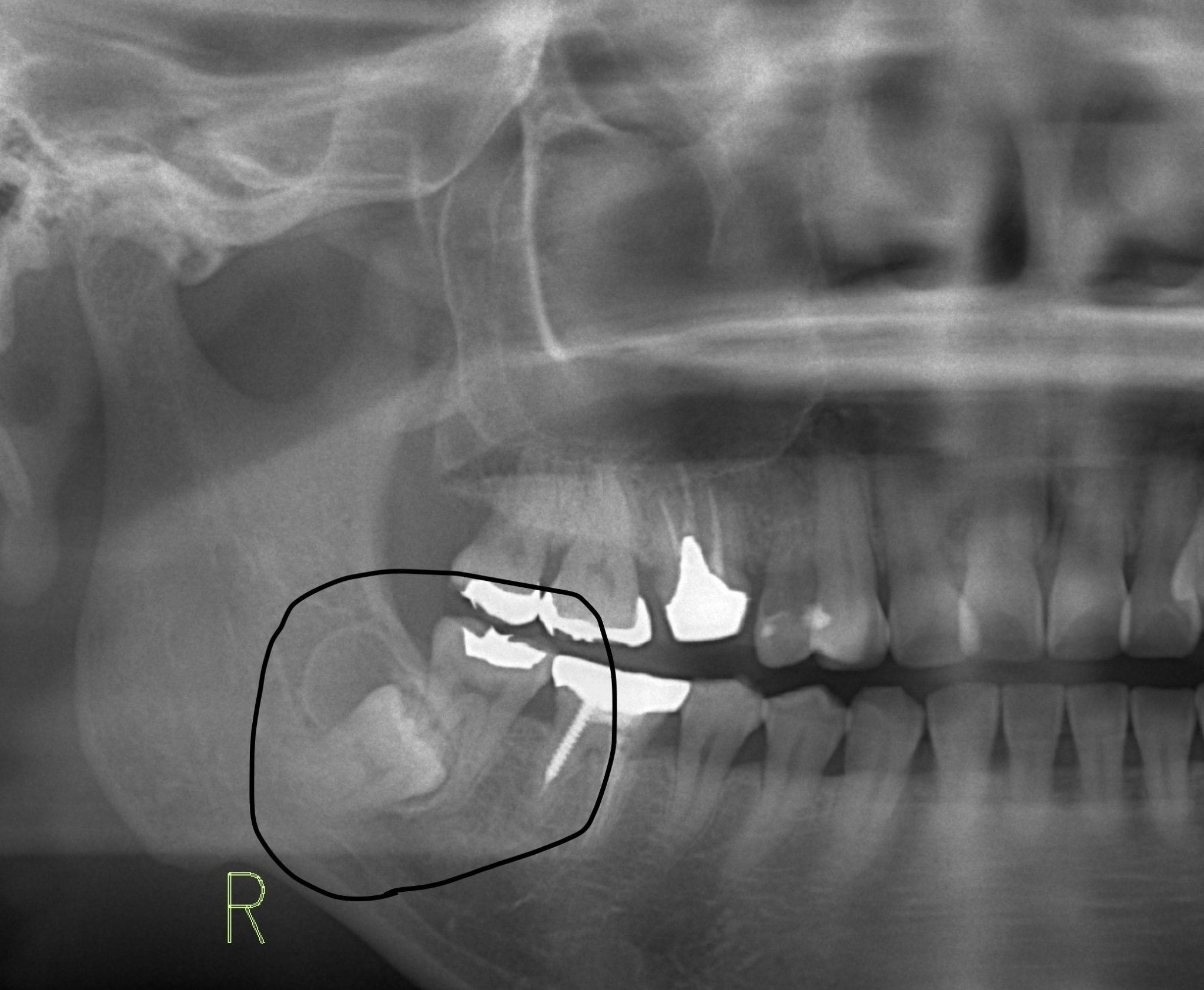 濾胞性嚢胞の原因は何ですか?