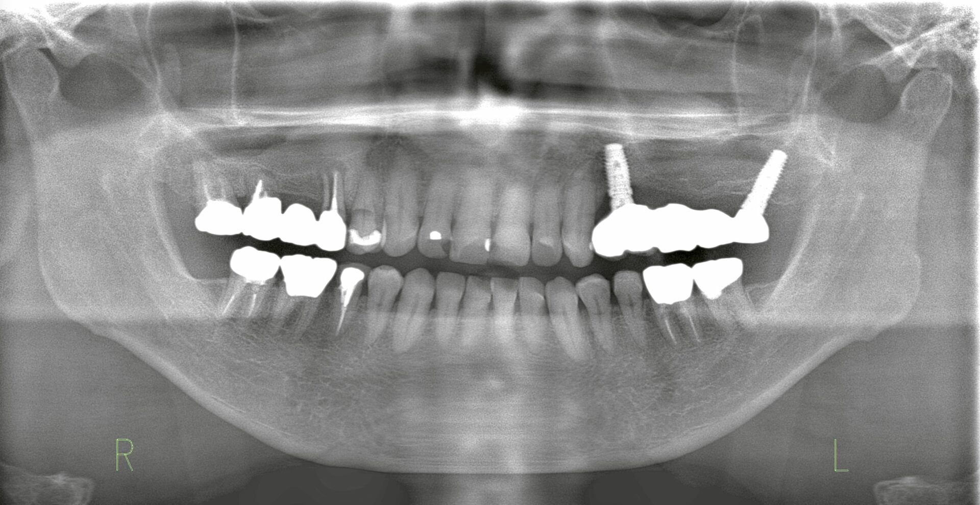 右上サイナスリフト術前レントゲン写真