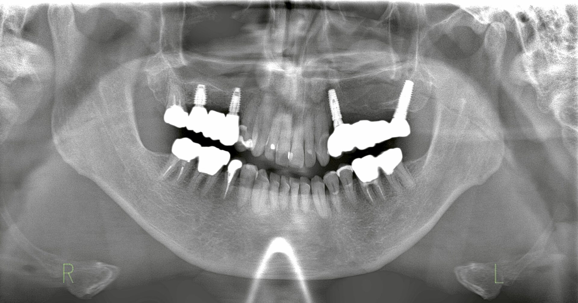 右上サイナスリフト術後レントゲン写真