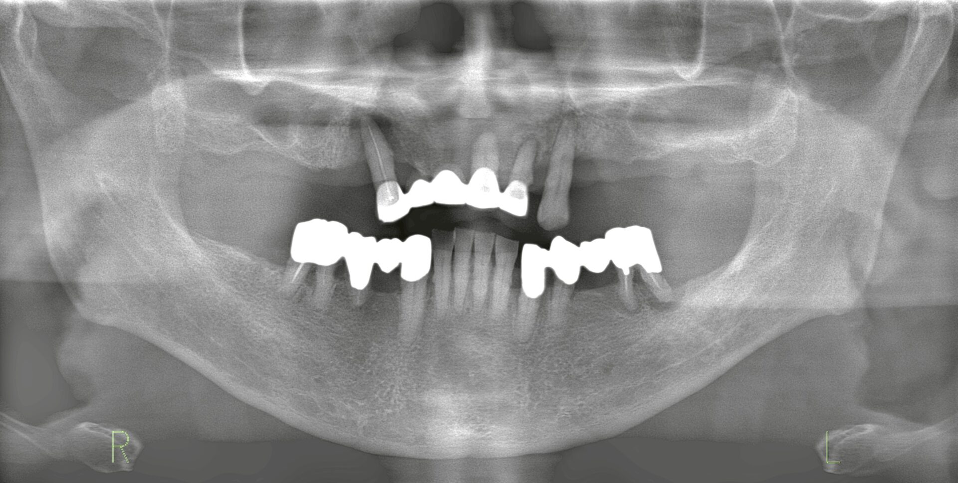 上顎のブリッジが動揺して噛めない